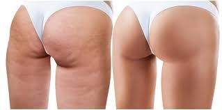 Cellulite Treatment Package